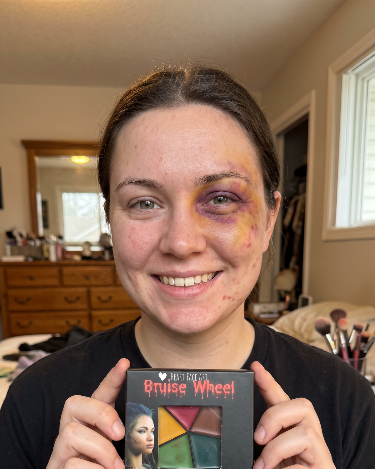 Realistic black eye and bruising painted with the Heart Face Art SFX Bruise Wheel