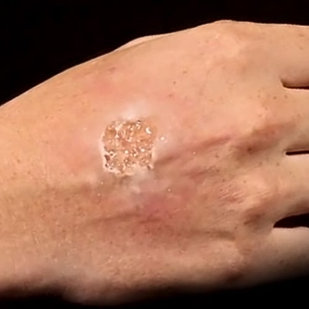 Grimas Burn Blister Gel 60ml